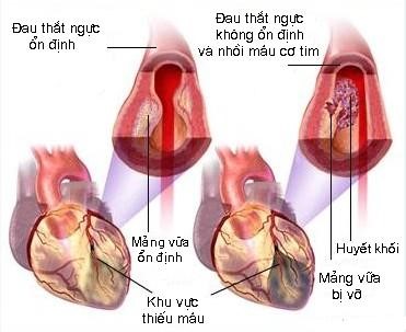 MỐI LIÊN QUAN GIỮA HUYẾT KHỐI VÀ MẢNG XƠ VỮA ĐỘNG MẠCH